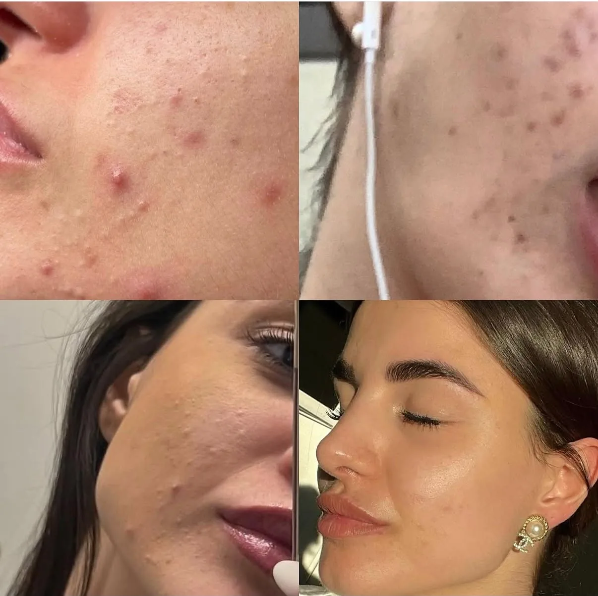 Risultati Prima e Dopo Needling Viso NEMEA